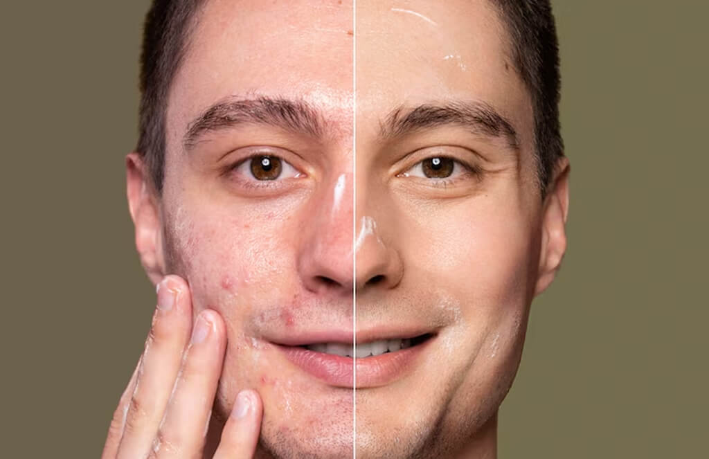 face-with-scars-before-after-1 - MidyDove Fashion Store Face with Scars and Pours Before and After